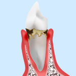 歯槽膿漏の原因イメージ