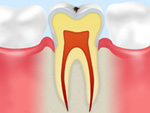 エナメル質のむし歯イメージ
