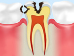 象牙質のむし歯イメージ